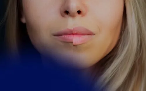 Lip Filler Before and After: How to Achieve Top Lip Enhancement Results