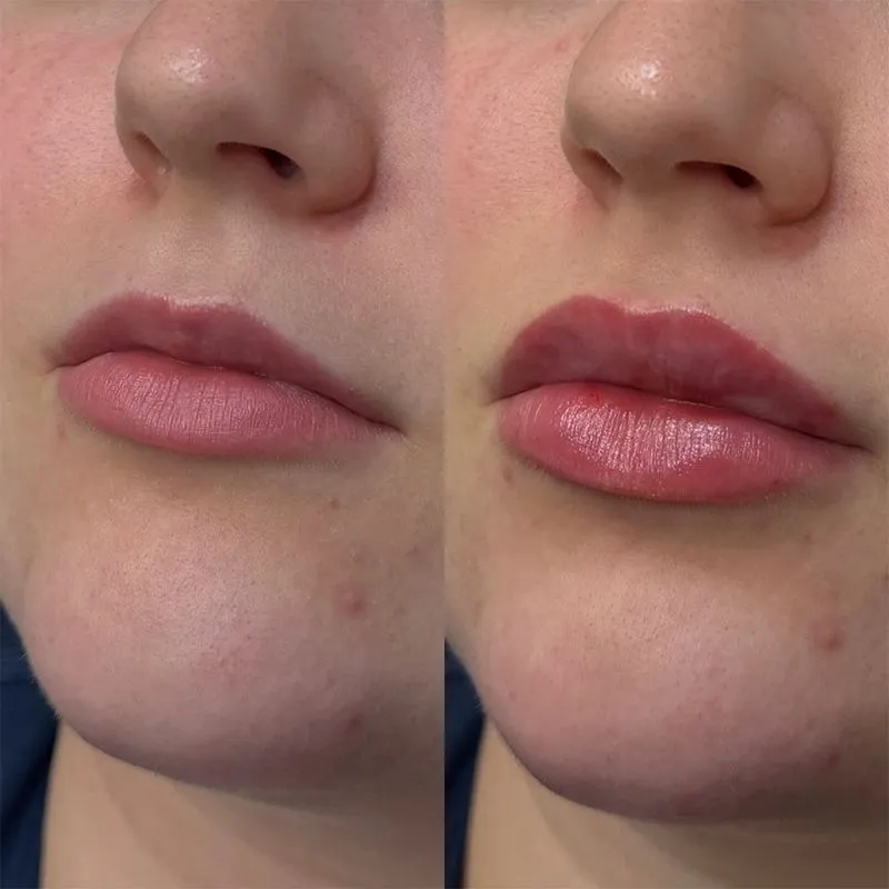 Lip Filler Before and After