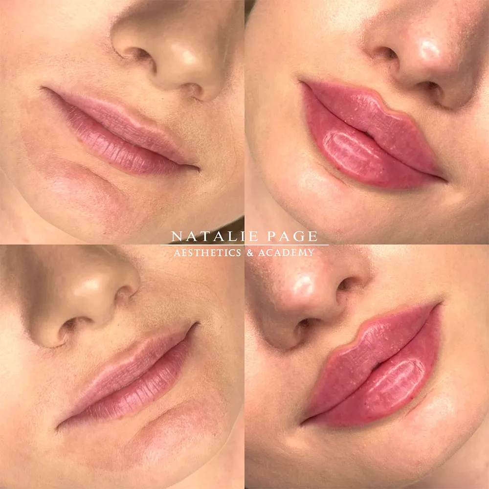 Lip Filler Before and After Examples