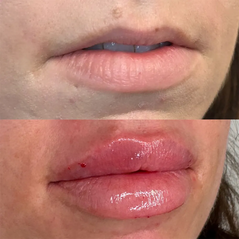 Lip Filler Before and After Upper Lip