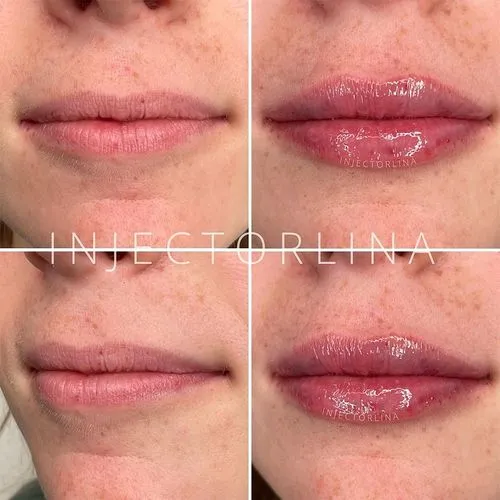 Lip Filler Before and After Photos