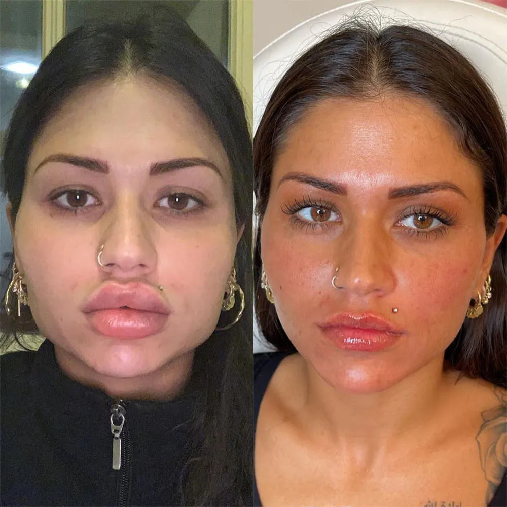 Pillow Face Before and After Example