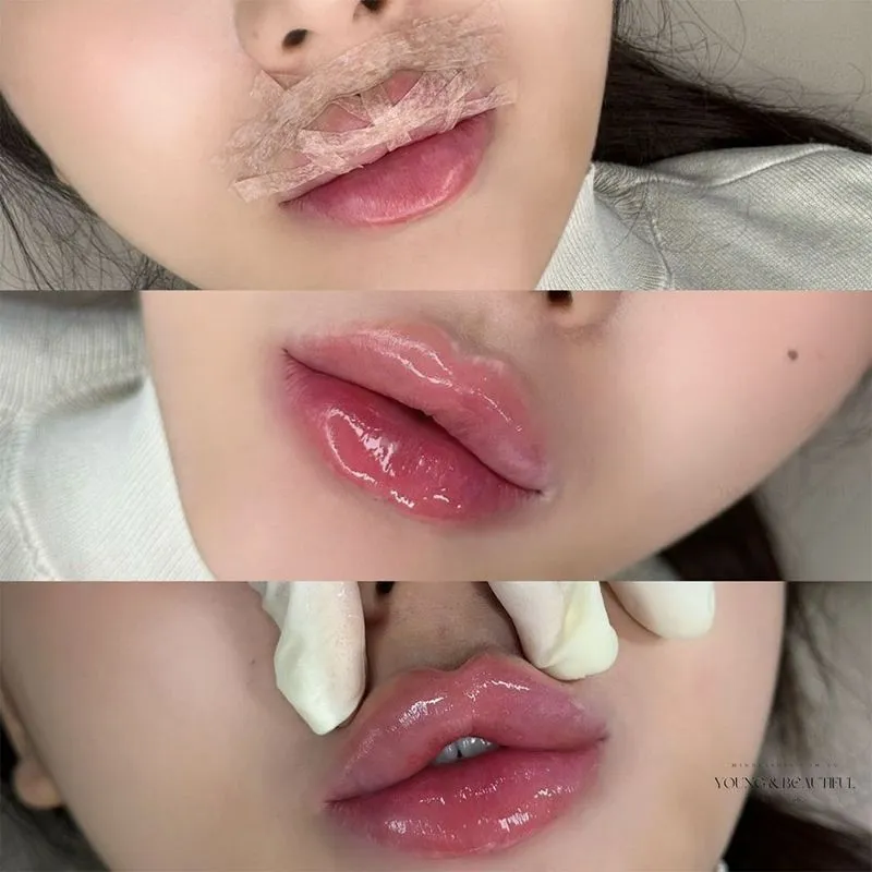 Korean Lip Filler Technique
