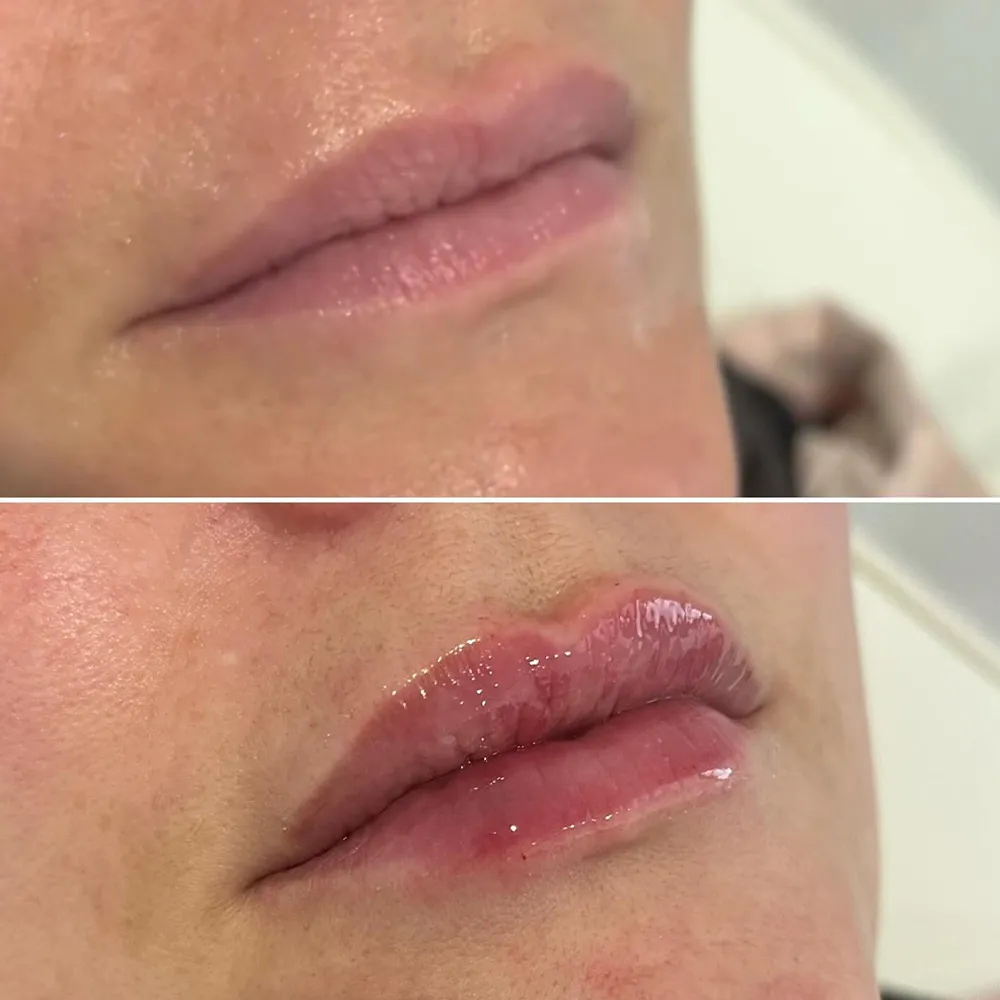 Natural Lip Filler photo