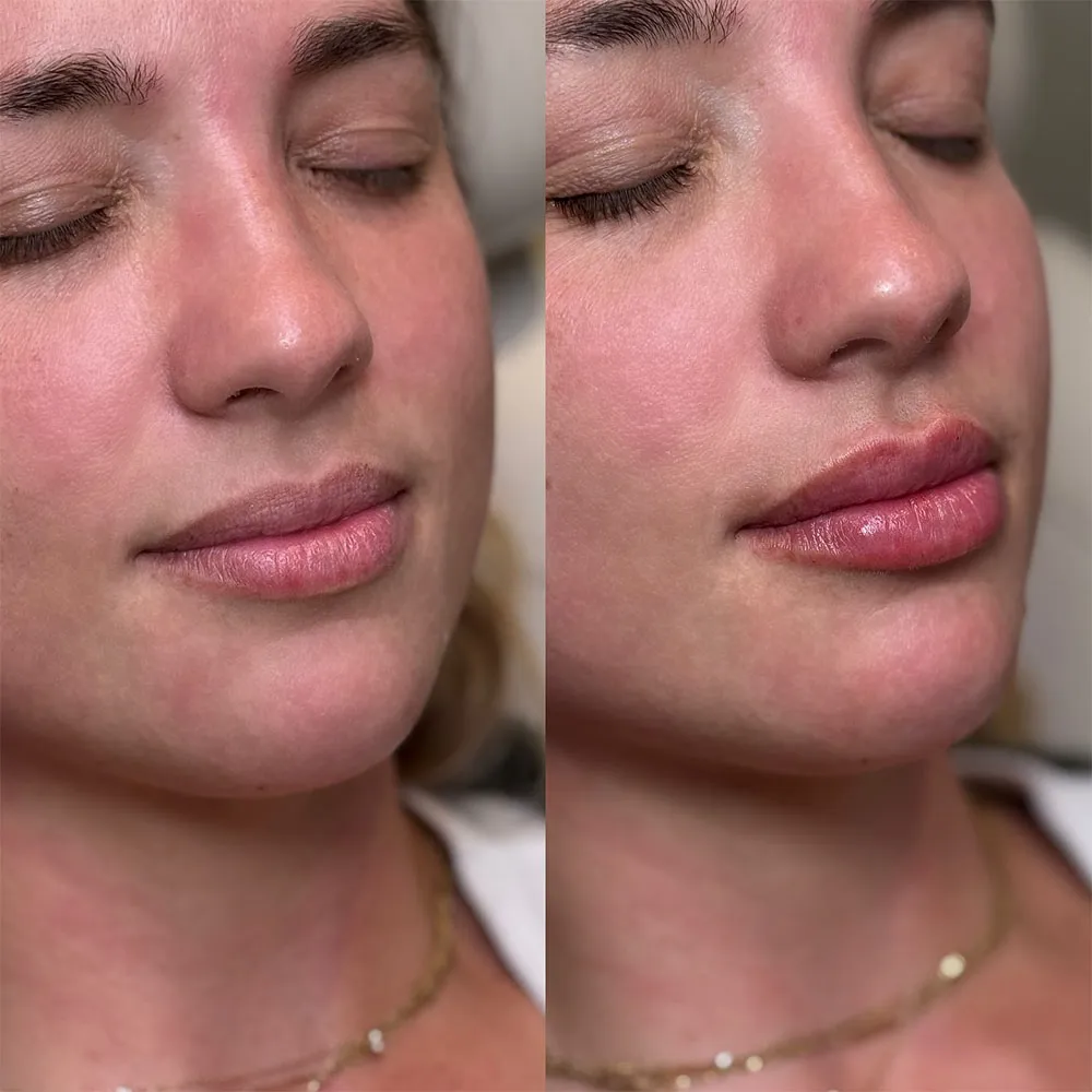 Natural Lip Filler