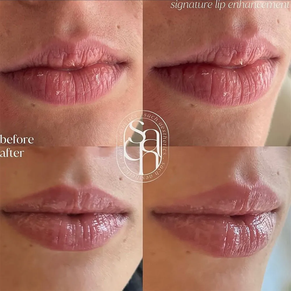 Natural Lip Filler