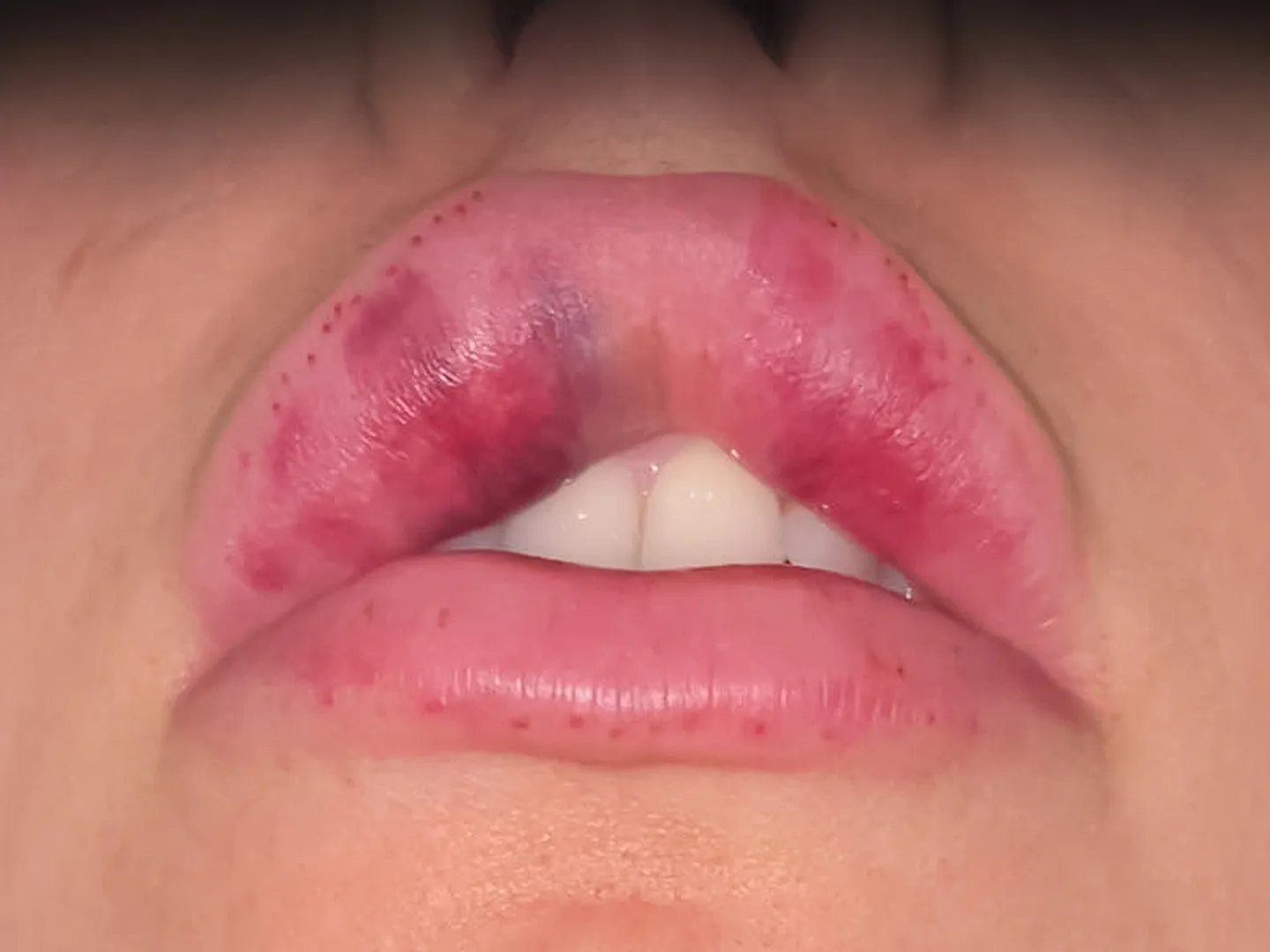 Lip Filler Necrosis Explained: How to Avoid and Treat It