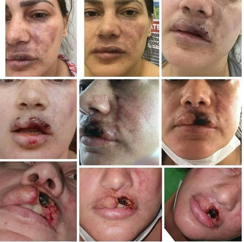 lip filler necrosis