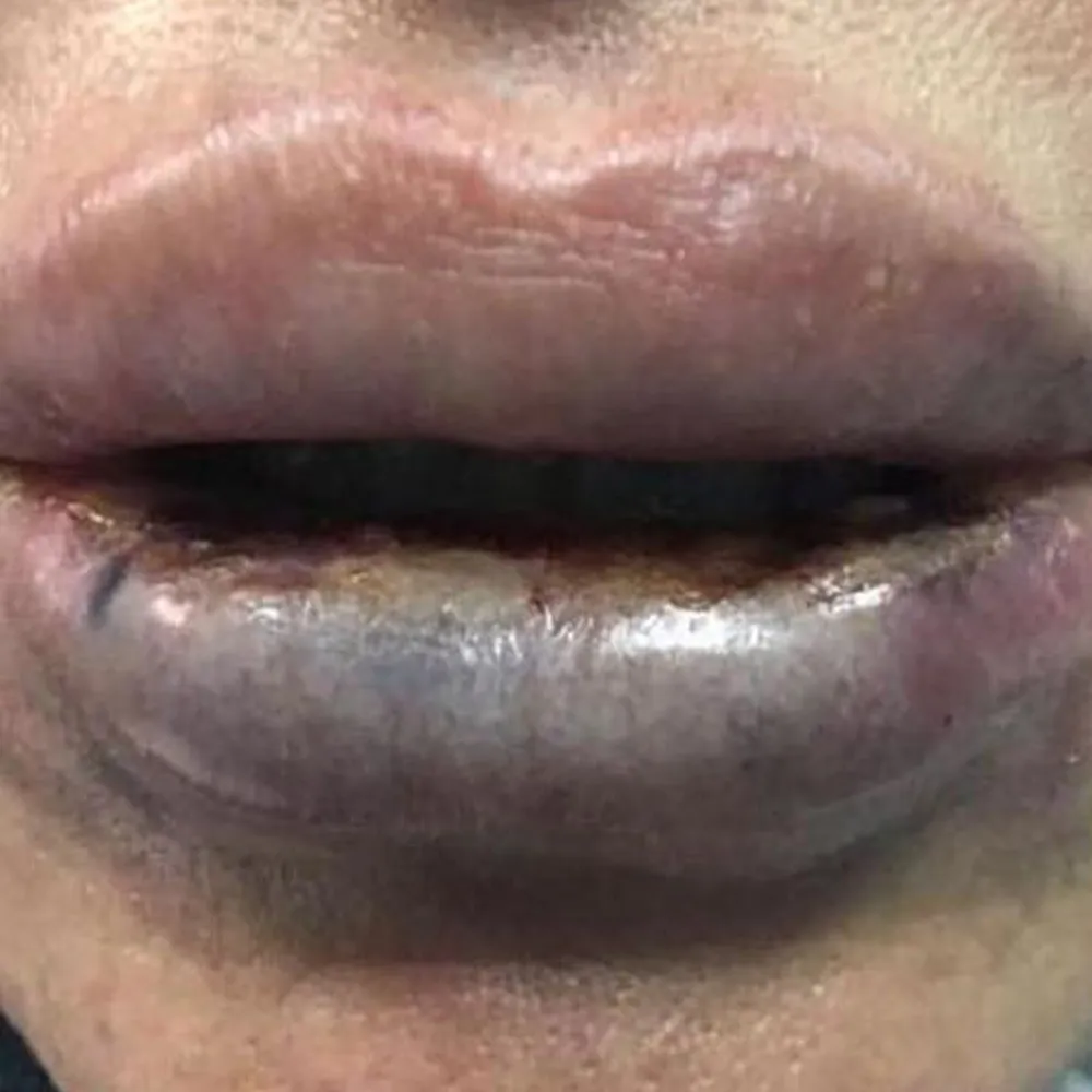 lip filler necrosis