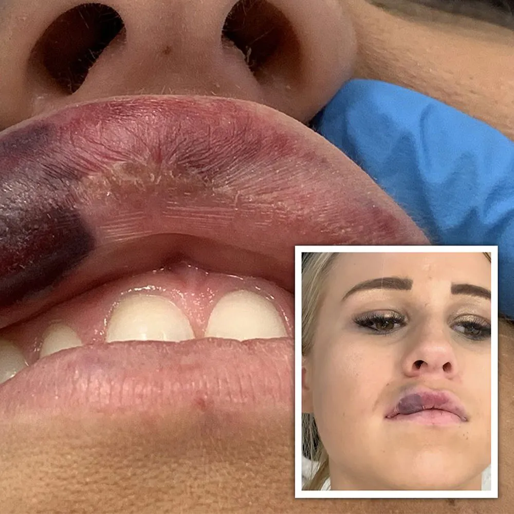 lip filler necrosis example