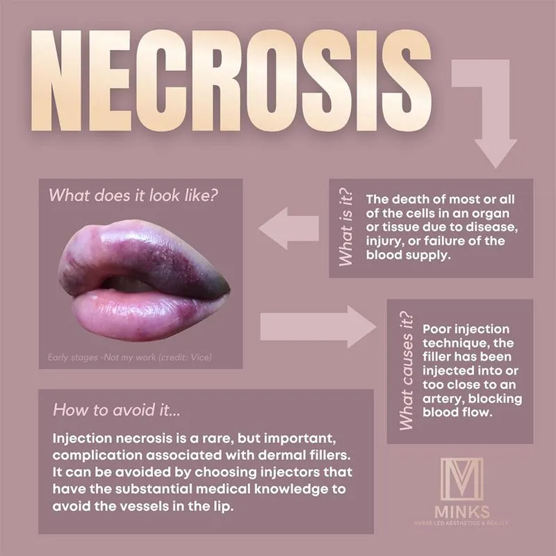 lip filler necrosis infographic