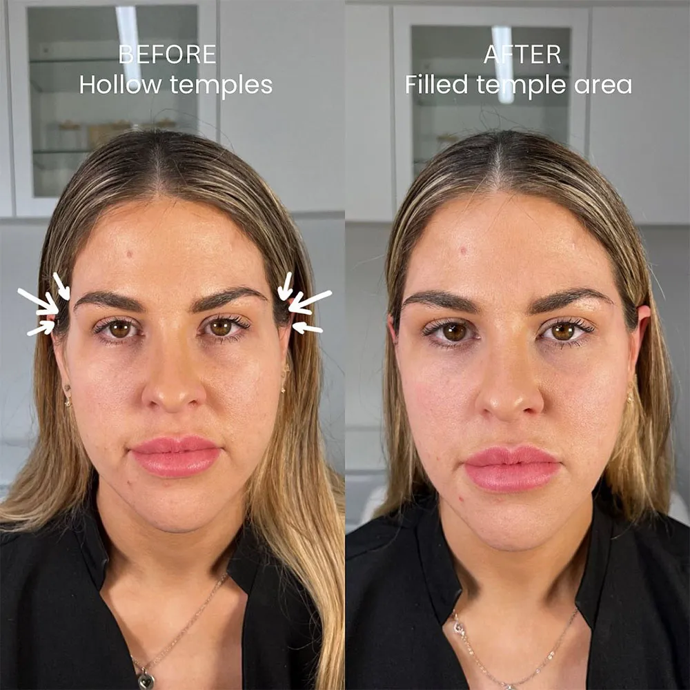 temple filler before and after