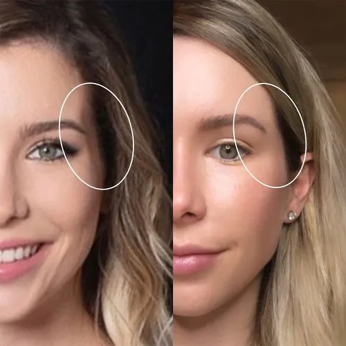 temple filler before and after