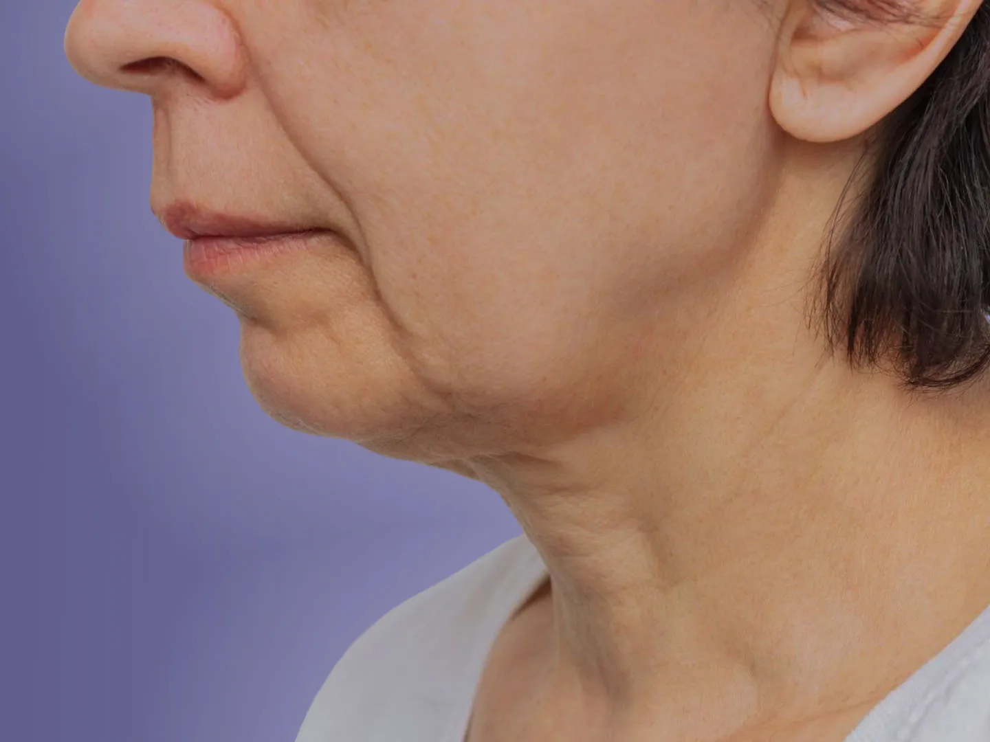 What Are Sagging Jowls: Causes + Best Treatment Options For Sagging Jowls