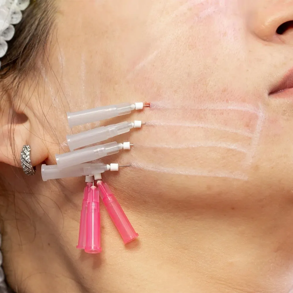Best Treatment for Skin Laxity PDO Threads