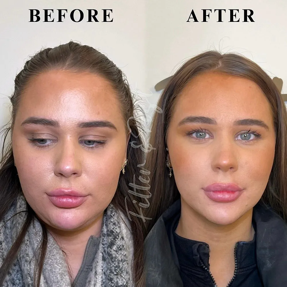 botox for sagging jowls