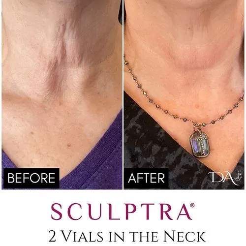 Non-Surgical Neck Lift