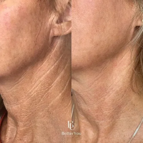 Non-Surgical Neck Lift