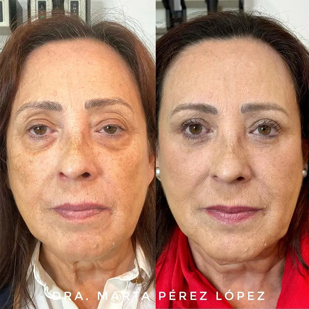 ptosis treatment without surgery