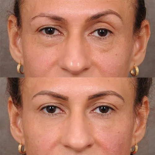 ptosis treatment without surgery