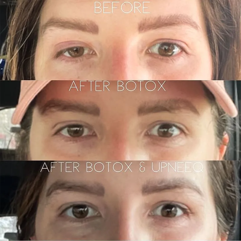 ptosis and botox