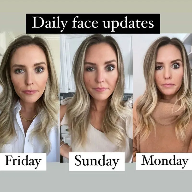 ptosis after botox