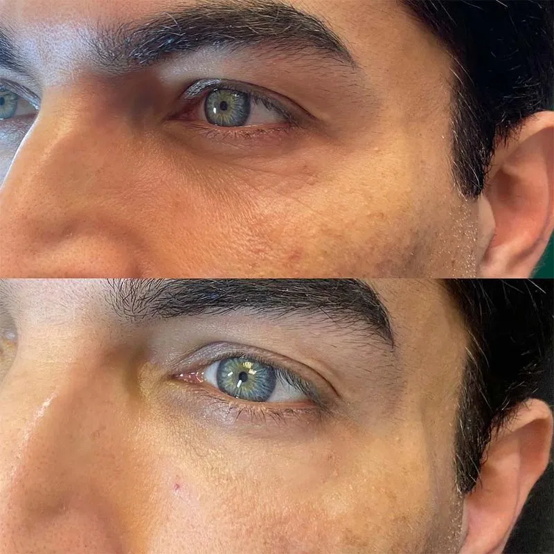 under eye crepey skin treatment