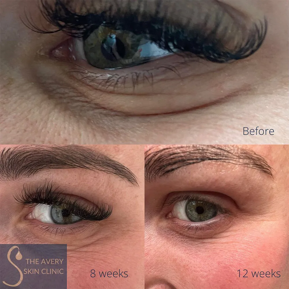 under eye crepey skin treatment