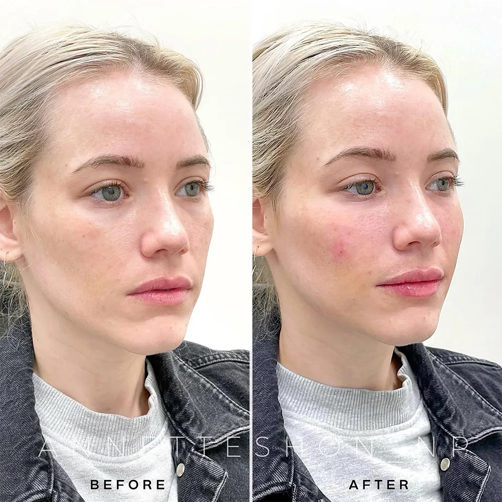 midface volume loss explained