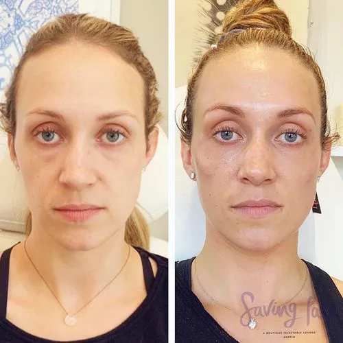 midface volume loss explained