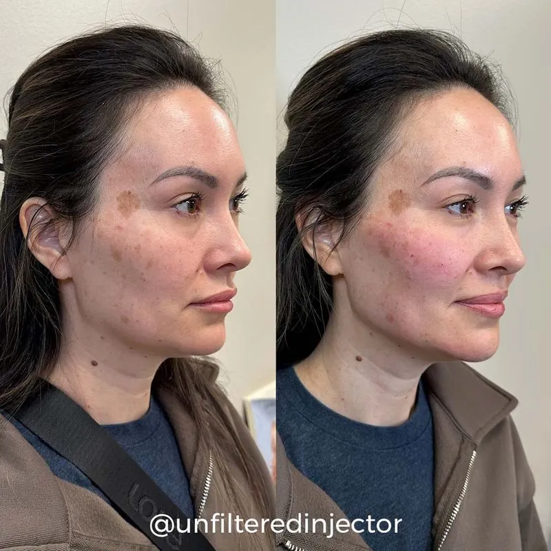 cheek filler before and after