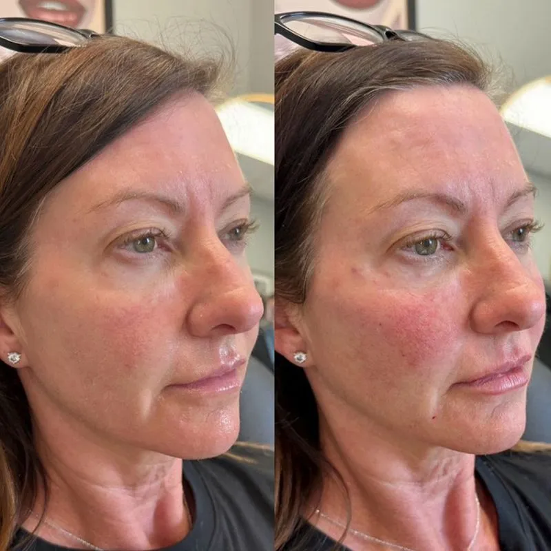 cheek filler before and after
