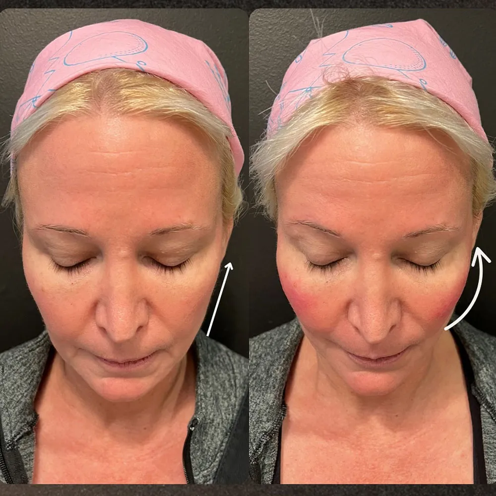 cheek filler before and after