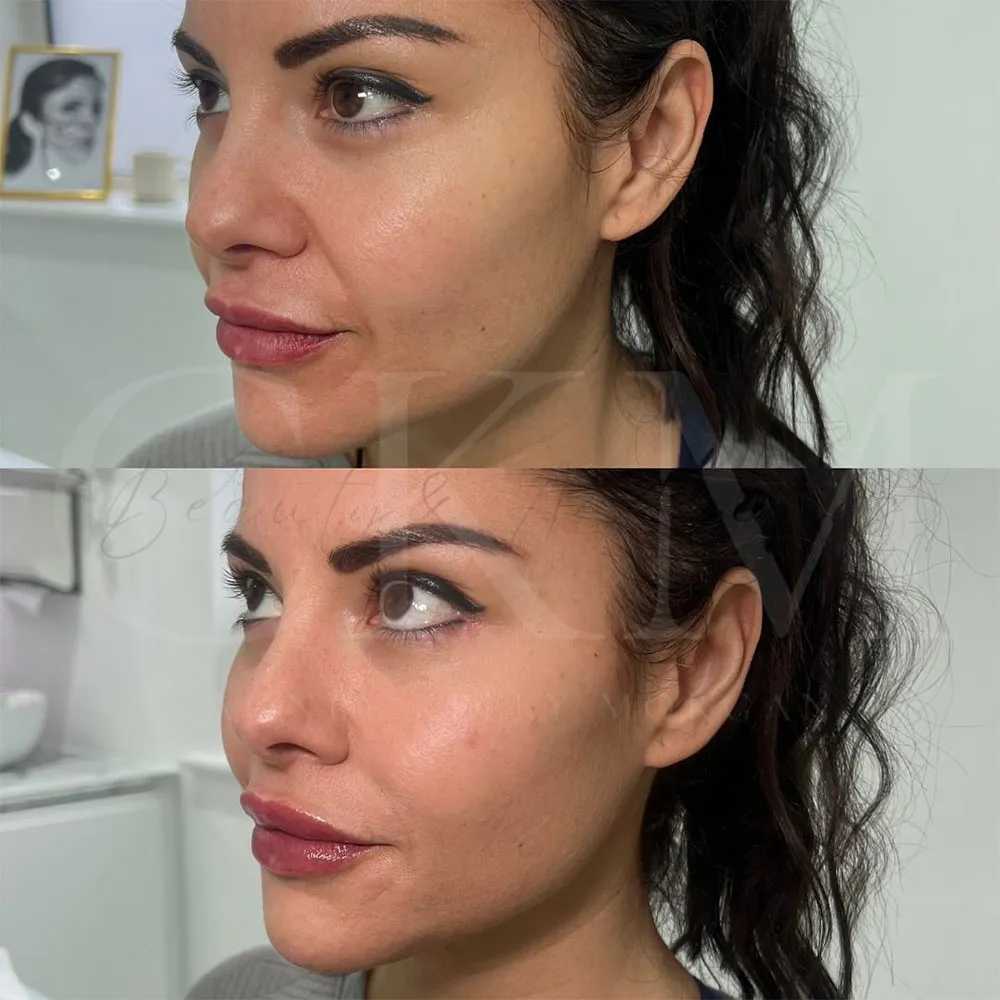 how long does cheek filler last