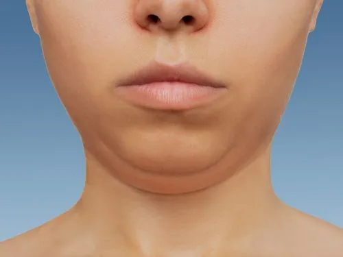Double Chin Treatments: Best Non-Surgical Options for a Defined Jawline