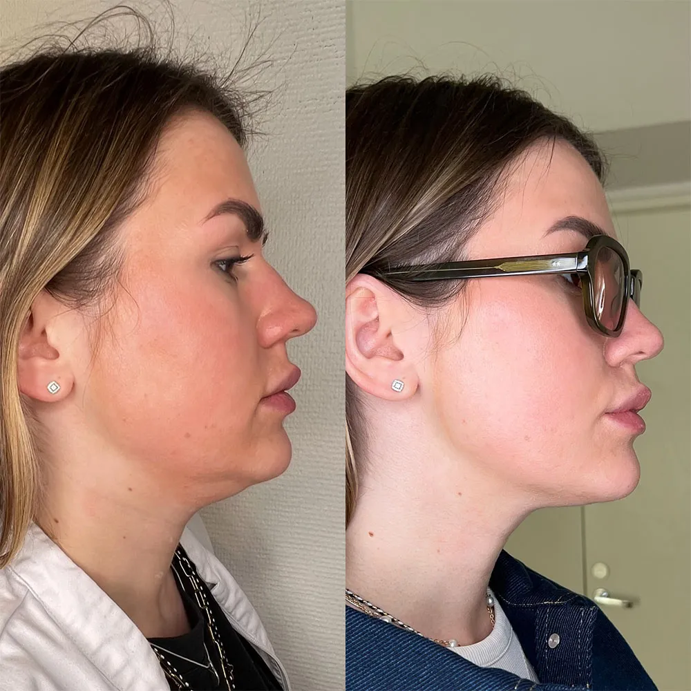 double chin treatments