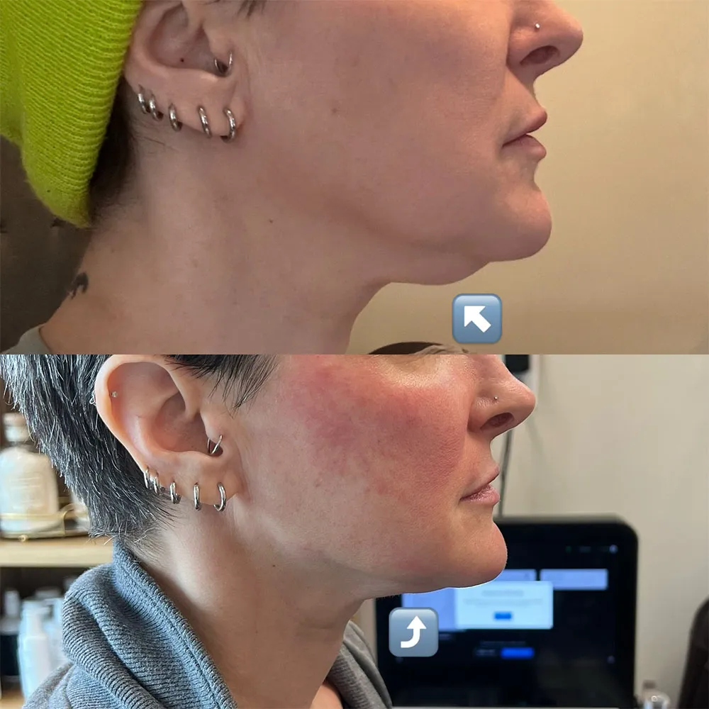 double chin treatments
