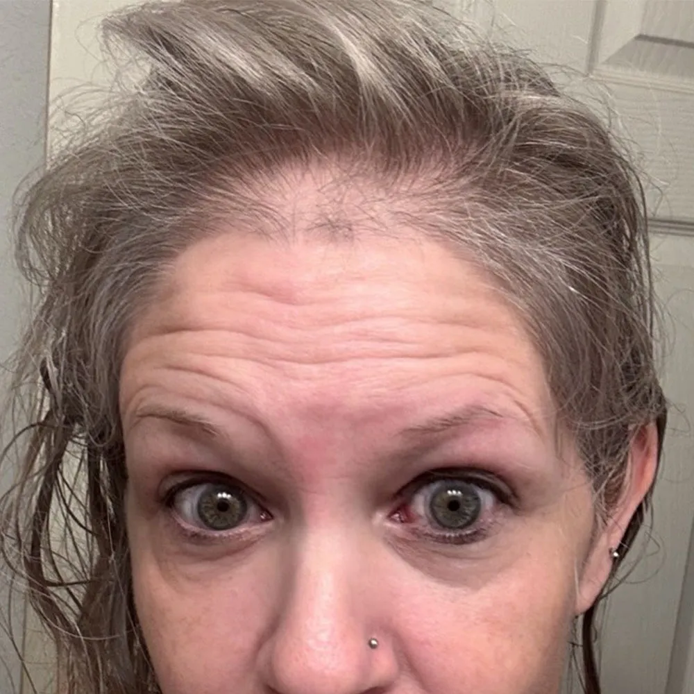 does mounjaro cause hair loss