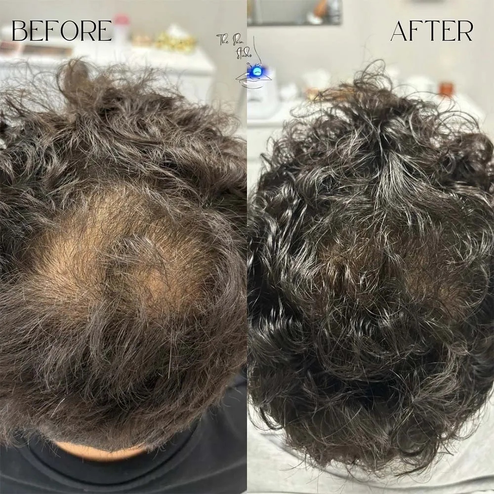 does mounjaro cause hair loss