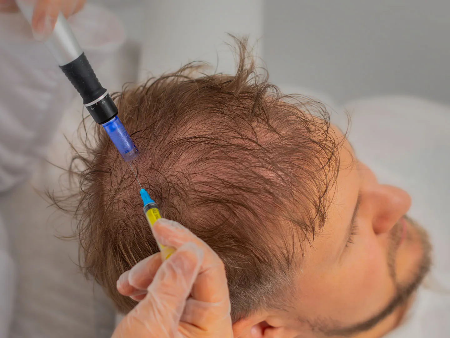 Exosomes for Hair Loss: A Breakthrough in Regenerative Treatment