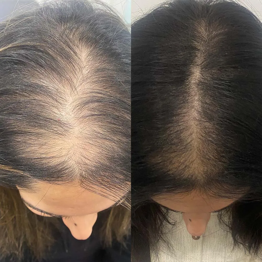prp for hair loss