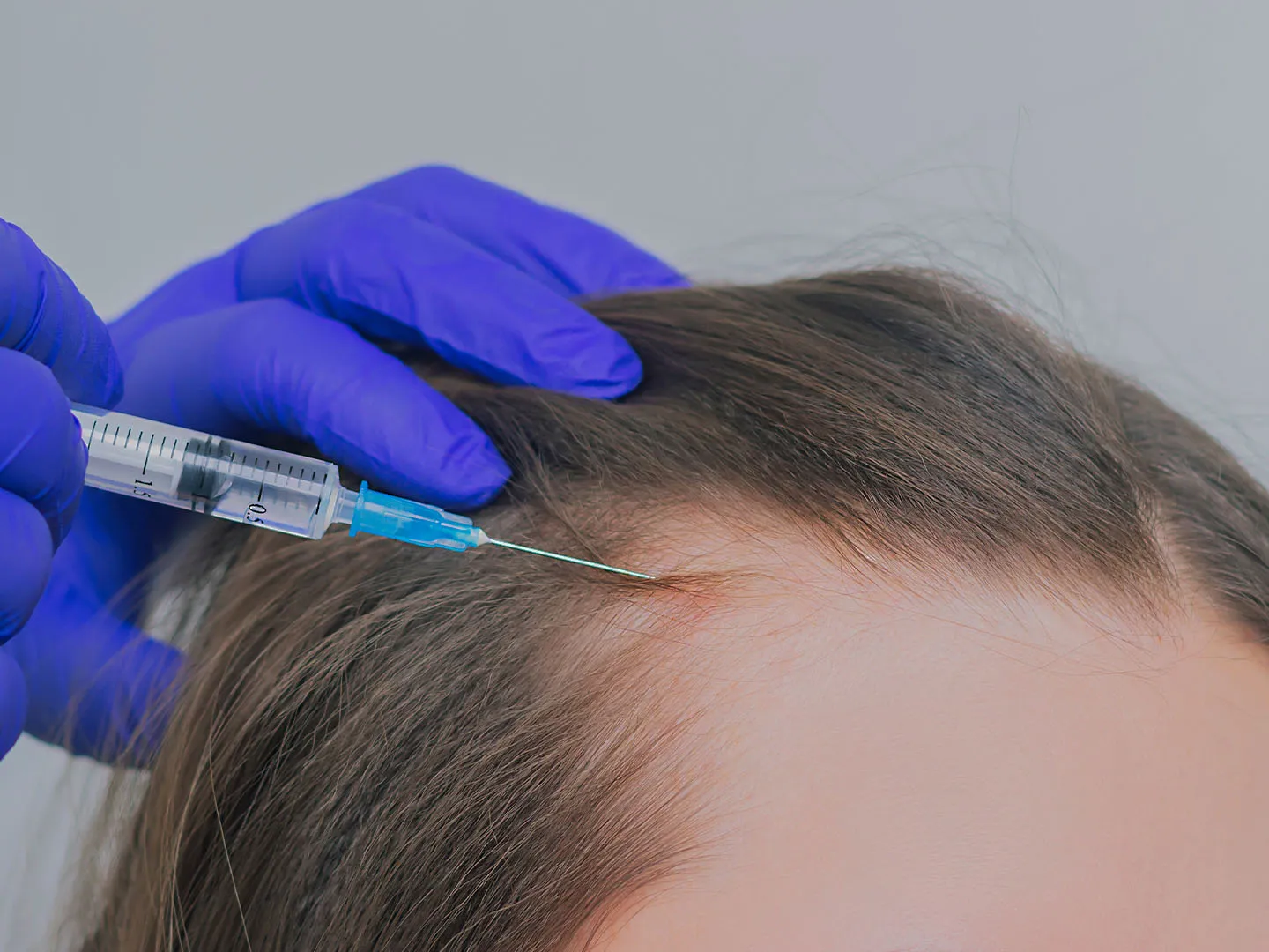 Polynucleotides Hair Loss Treatment: What to Expect and Who It’s For