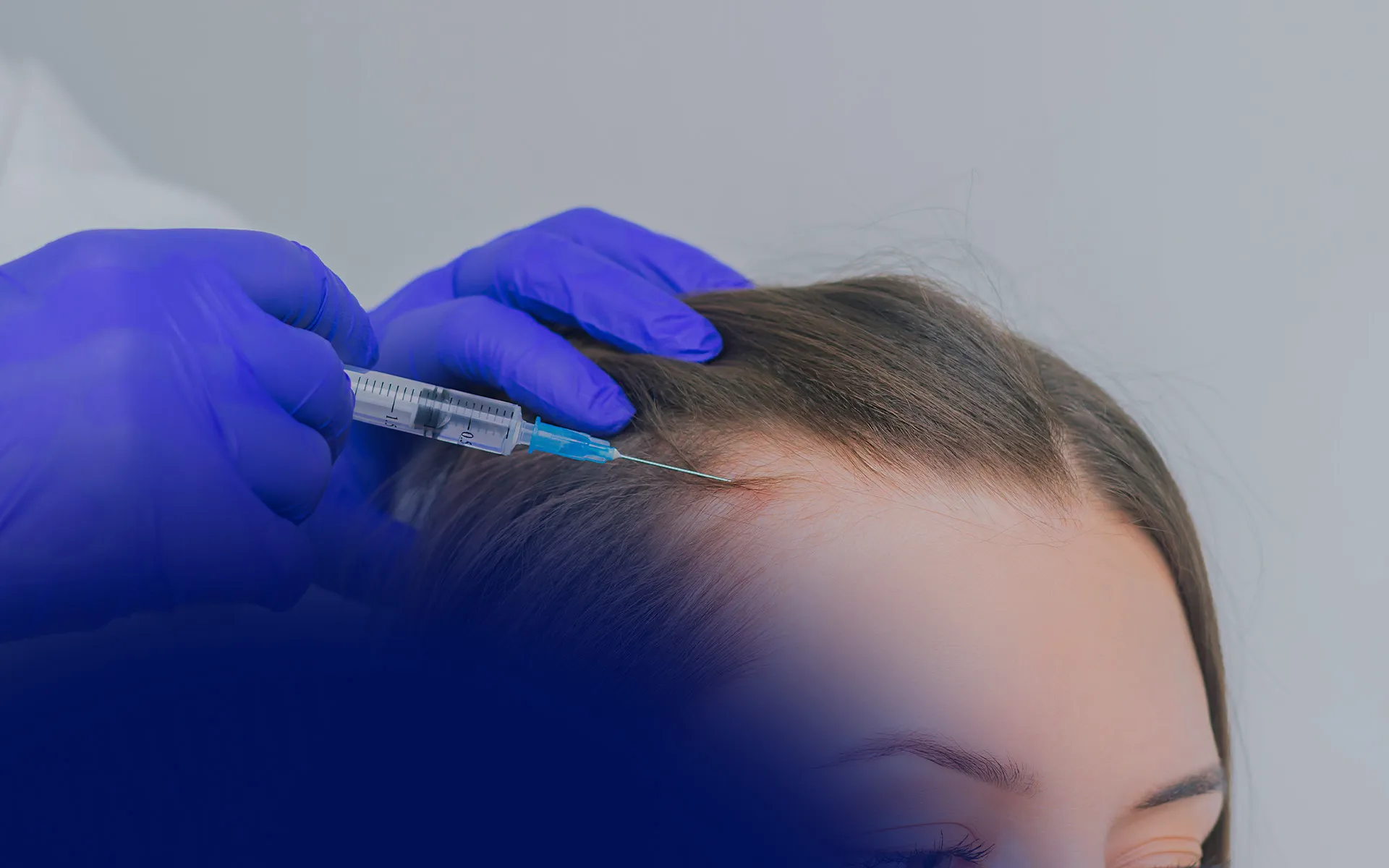 Polynucleotides Hair Loss Treatment: What to Expect and Who It’s For
