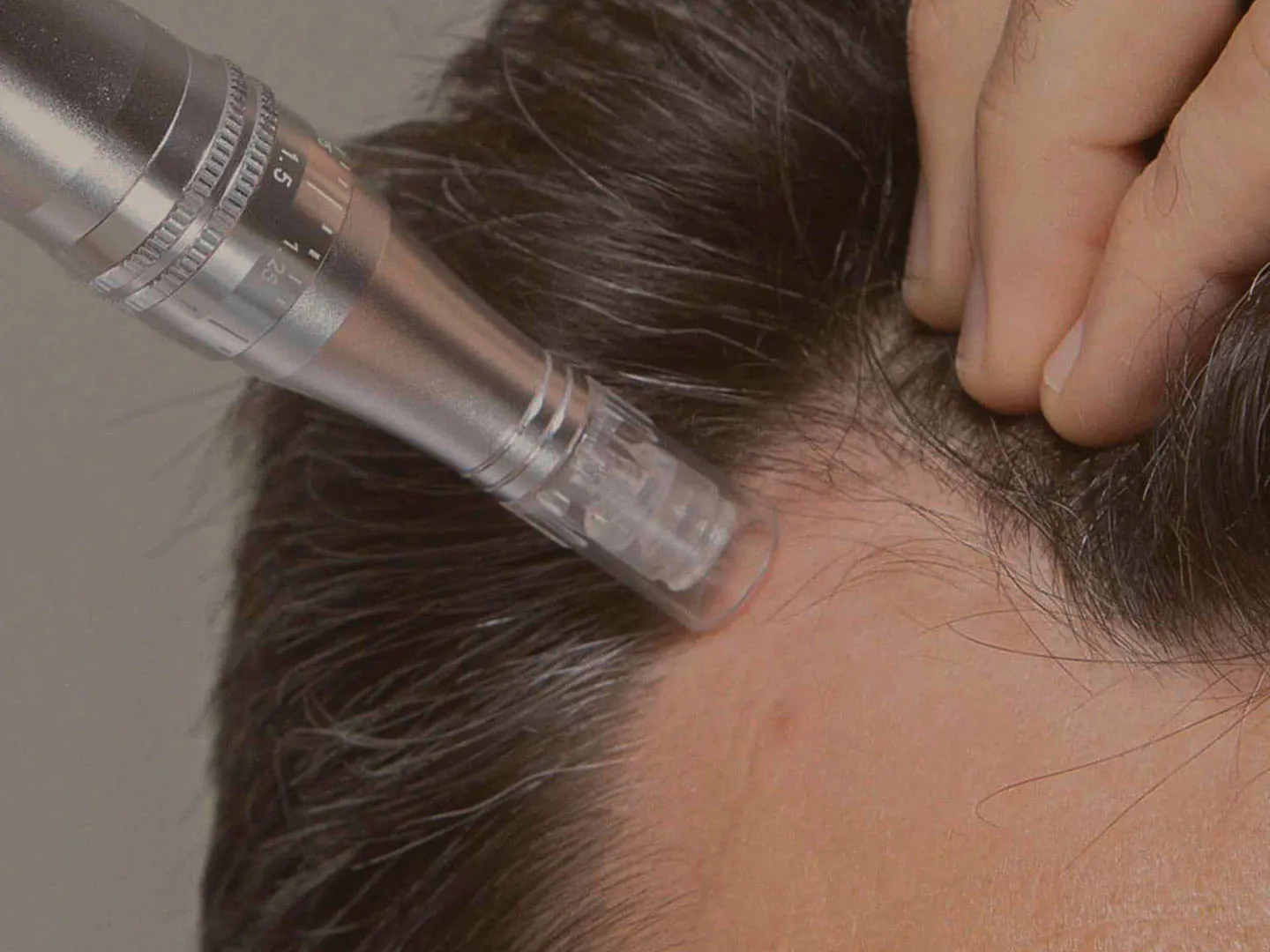Microneedling for Hair Loss: How It Works and Why It’s Effective