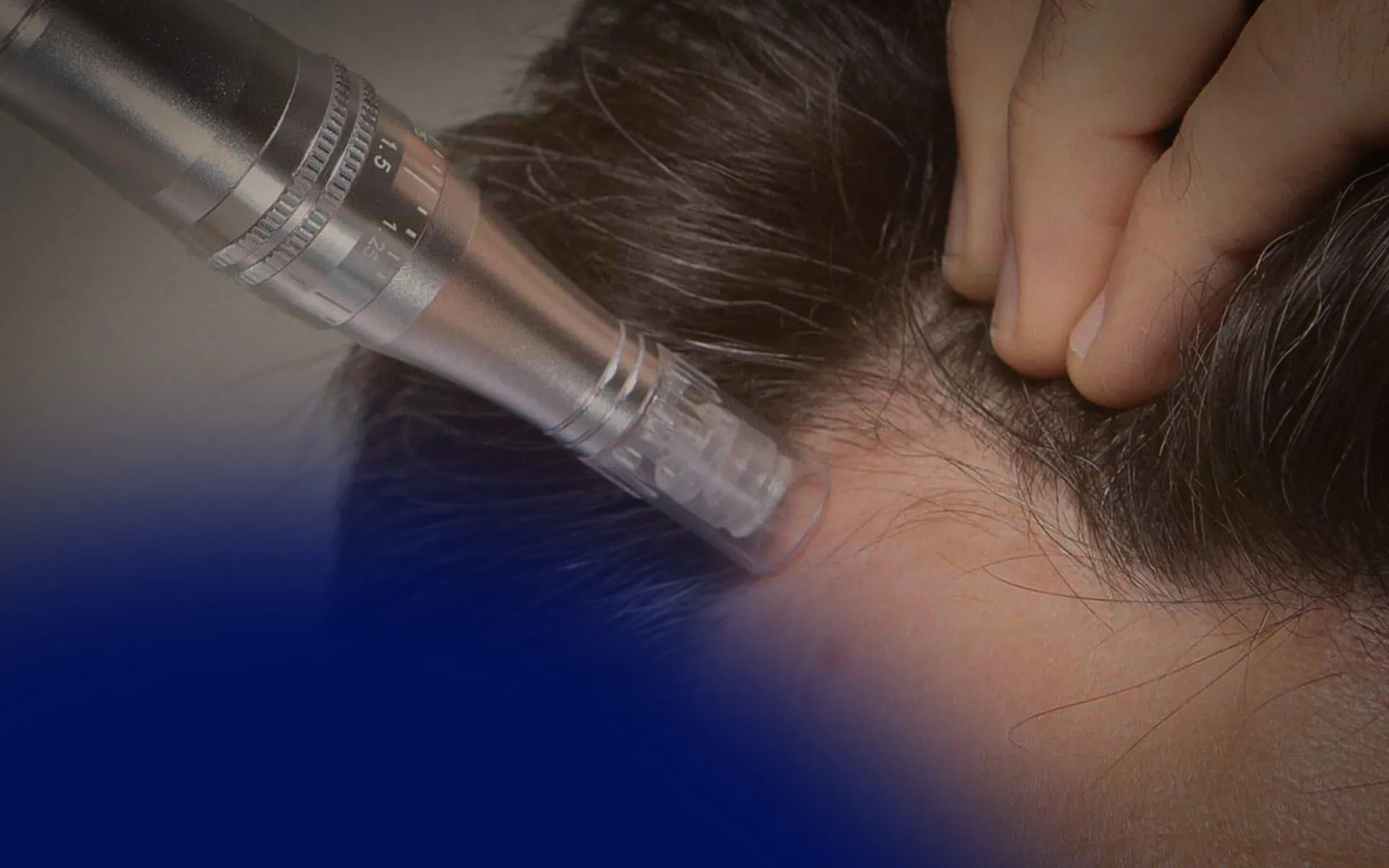 Microneedling for Hair Loss: How It Works and Why It’s Effective