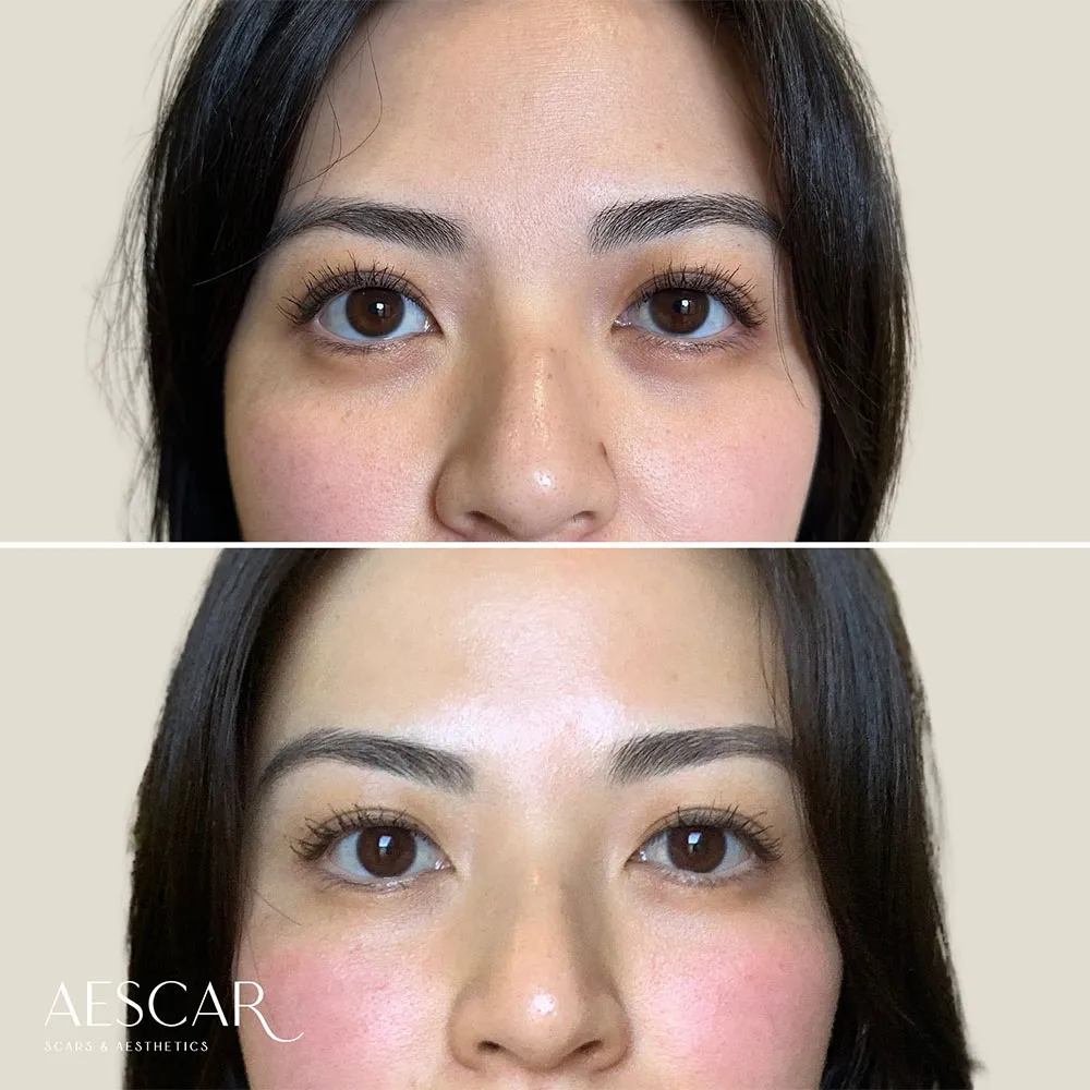 exosomes under eyes