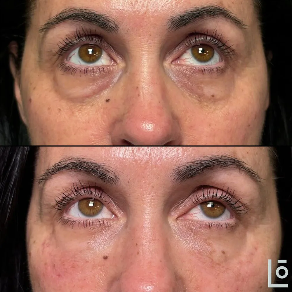 exosomes under eyes