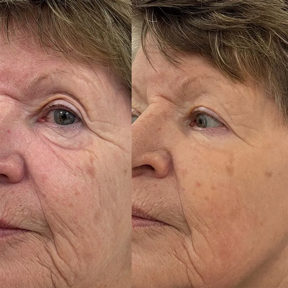exosomes under eyes