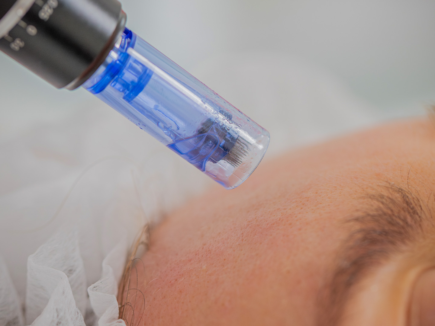 Microneedling with Exosomes - What Are the Advantages?