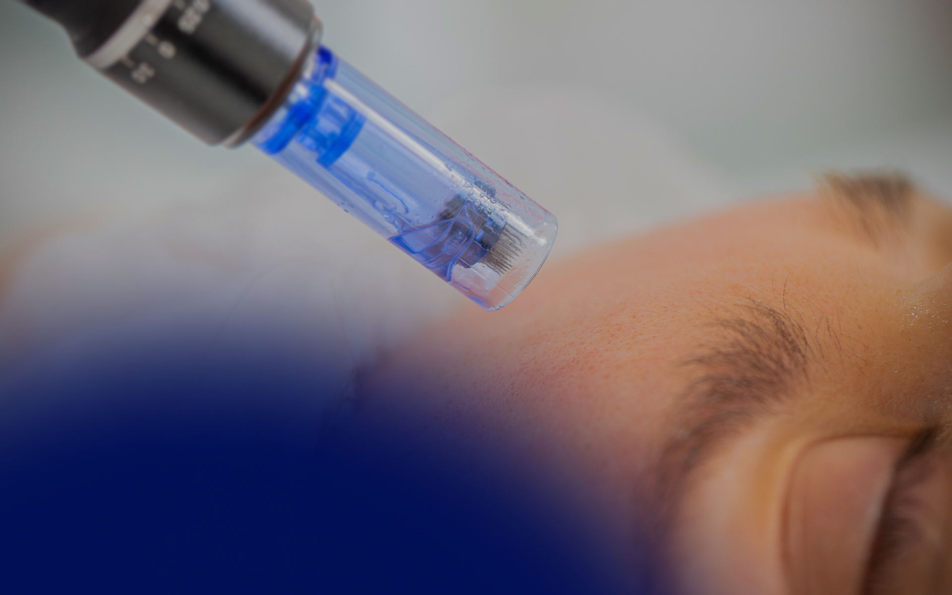 Microneedling with Exosomes - What Are the Advantages?